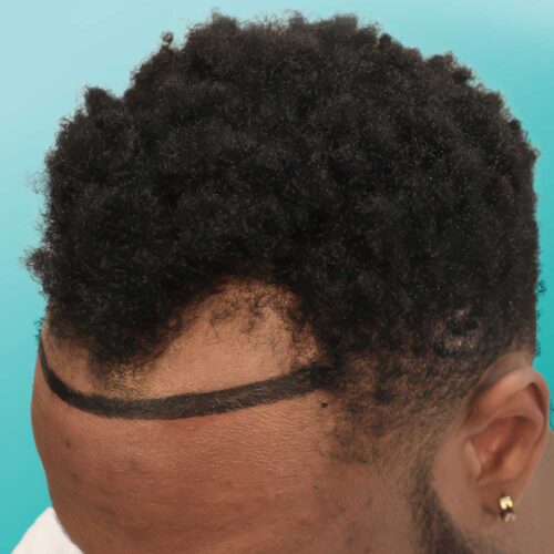 Afro Hair Transplant