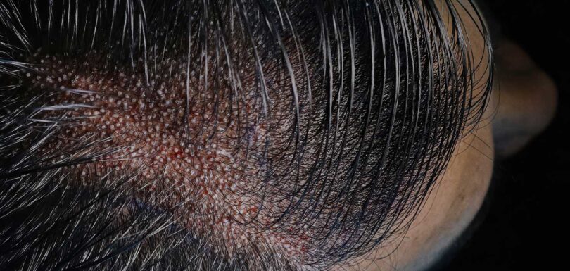 Unshaven Hair Transplant