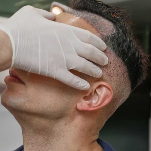Unshaven Hair Transplant