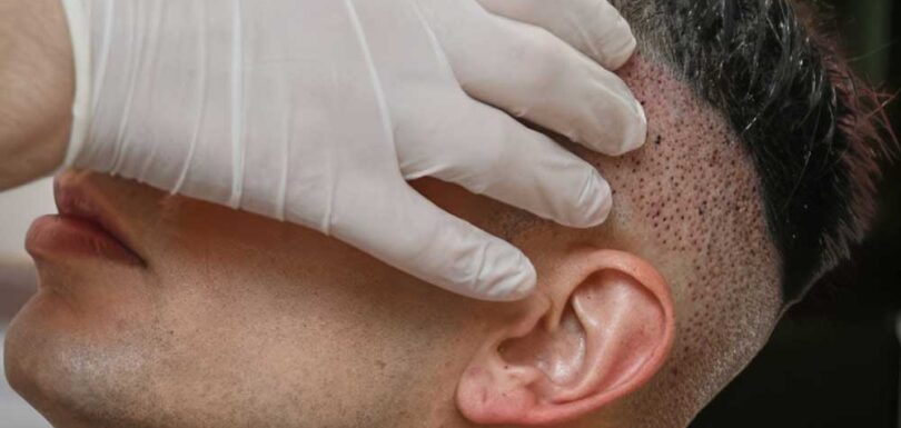 Unshaven Hair Transplant