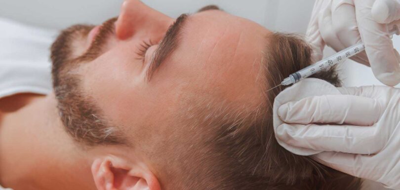 Hair Transplant with Stem Cell