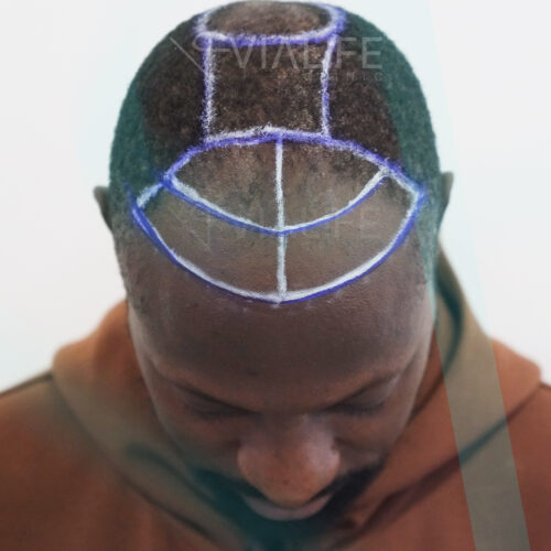 vialife-afro-hair-transplant