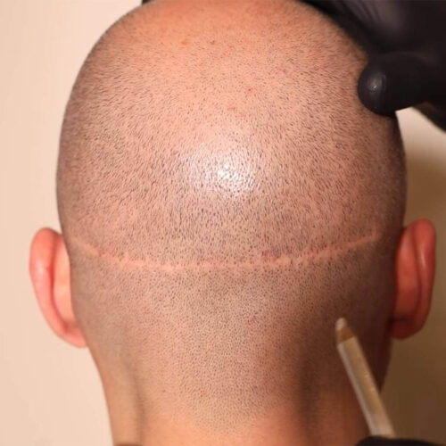 hair-transplant-scar