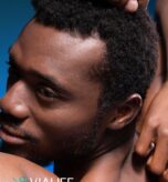 Afro Hair Transplant