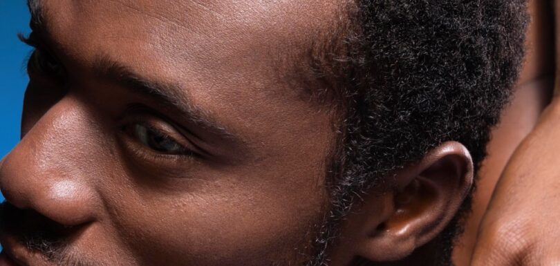 Afro Hair Transplant